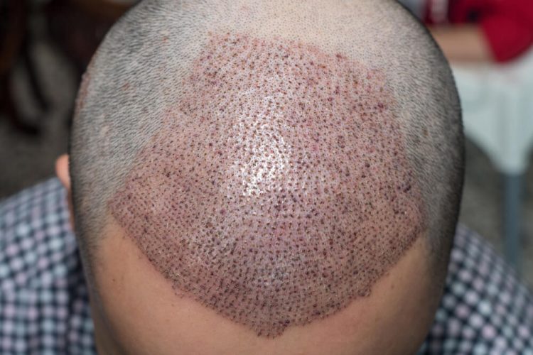 Benefits from hair transplant surgery